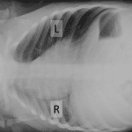 Right side down decubitus view shows expected volume loss in the right lung with rightward mediastinal shift.