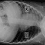 Left side down decubitus view shows minimal if any change in volume of the left lung, indicating air trapping.