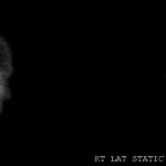 Nuclear medicine brain perfusion study showing absent cerebral perfusion as well as increased perfusion in the external carotid artery distribution (hot nose sign). This study supports a clinical diagnosis of brain death.