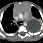 Red arrows: subsequent chest CT shows a fluid density lesion in the left posterior mediastinum, compatible with a bronchogenic cyst.