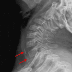 Red arrows: linear radiodensities in the proximal esophagus, which turned out to be ingested chicken bones.