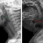 Nondistended pharynx and hypopharynx on the left in a comparison normal patient and abnormal distension on the right in this patient with croup.