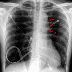 Abnormal bulging contour along the left margin of the proximal descending thoracic aorta (red arrows).