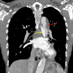 Comparison CTA in this patient shows the true lumen (yellow arrow) and partially thrombosed false lumen (red arrow) of this patient's type B aortic dissection.
