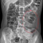 Dotted red oval: abnormal separation of loops of small bowel in the left hemiabdomen.