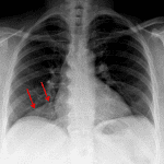 Clearly marginated hazy density along the medial right lung base (red arrows).