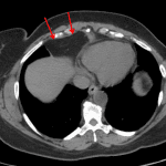 Comparison CT confirmed prominent epicardial fat (red arrows).