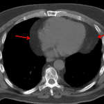 Comparison CT from this patient showing prominent pericardial fat (red arrows).