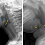 Normal comparison on the left, patient with epiglottitis on the right. Note the marked thickening of the epiglottis (blue arrows) and aryepiglottic folds (yellow arrows) in the patient on the right.