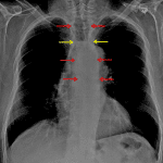 Dilated upper and mid esophagus (red arrows) with air-fluid level (yellow arrows).