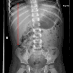 Red line: enlarged liver, measuring 14 cm in craniocaudal span.