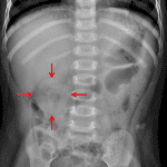 Red arrows: rounded soft tissue density in the right hemiabdomen.