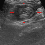 Red arrows: targetoid-appearing ileocolic intussusception confirmed on the subsequent ultrasound.