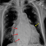 Bulging left atrial appendage (yellow arrow). Splaying of the carina (blue dotted lines). Double density sign (red arrows).