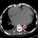 CT confirms marked left atrial enlargement (red arrows).