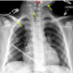 Red arrow: internal portion of the enteric tube overlying the upper neck. Yellow arrows: external portion of the enteric tube.