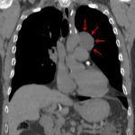 CT demonstrated a middle mediastinal mass most consistent with a benign duplication cyst (red arrows).