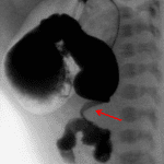 Upper GI series in this patient shows a distended proximal duodenum with a corkscrew appearance of the distal duodenum (red arrow), which is malrotated.