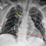 Red arrow: Kerley B lines consistent with interstitial edema. Yellow arrow: dilated azygos vein. Blue arrows: engorged pulmonary vessels. Red dotted line: enlarged cardiac silhouette. Purple arrow: groundglass opacities likely representing early alveolar edema.