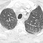Comparison CT in this patient showing bilateral interlobular septal thickening in the lung apices consistent with interstitial edema.