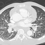 Miliary pattern of numerous micronodules on this patient's CT.