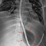 Inflation of the gastric balloon.