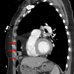 Comparison CT in this patient showing the bowel-containing Morgagni hernia (red arrows).