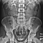 Normal intravenous pyelogram in a different patient showing the expected course of the ureters.