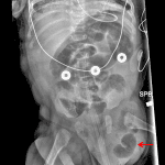 Red arrow: dilated bowel loop in a left inguinal hernia.