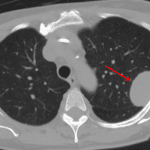 Corresponding CT in this patient showing a large left pleural mass (red arrow).