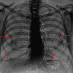 Bone sensitive dual-energy images shows multiple bilateral pleural plaques (red arrows).
