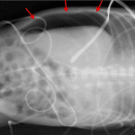 Red arrows: large volume pneumoperitoneum on left side down lateral decubitus view.