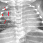 Red arrows: posterior mediastinal mass. The upper right cardiothymic silhouette is NOT obscured, indicating that this mass is not in the anterior or middle mediastinum. Red line: splaying of the 3rd and 4th ribs.