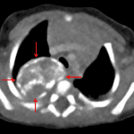 Red arrows: partially calcified right posterior mediastinal mass confirmed on the subsequent chest CT. This imaging appearance is typical for thoracic neuroblastoma in this age group.