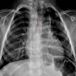 Red line: impression on the right aspect of the trachea from a right aortic arch.