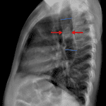 Blue lines indicate the diameter of a patulous, gas-filled esophagus. Red arrows: impacted food bolus.