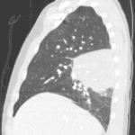 This patient did get a CT which confirms the area of masslike consolidation consistent with round pneumonia