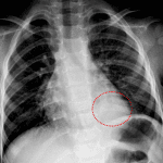 Red dotted oval: retrocardiac masslike opacification which is subtle on frontal radiograph.
