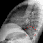 Red dotted oval: retrocardiac masslike opacification, easier to see on the lateral view.