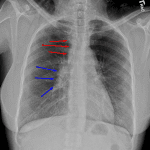 Red arrows: widening of the right paratracheal stripe. Blue arrows: right hilar lymphadenopathy.