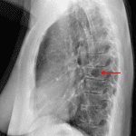 Lucency projecting over a midthoracic vertebral body (red arrow).