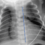 Spinnaker sail appearance of the thymus due to pneumomediastinum.
