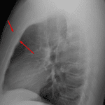 Red arrows: acute mildly displaced sternal body fracture.