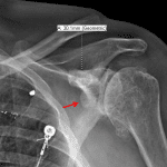 Type V acromioclavicular (AC) separation with widening of the coracoclavicular distance to 30 mm. Red arrow: loose ossific body in the superior subscapular recess.