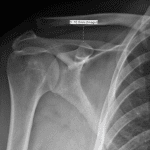Grade IV acromioclavicular (AC) separation with widening of the coracoclavicular distance to 18 mm.