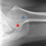 Grade IV acromioclavicular (AC) separation with posterior subluxation of the distal clavicle (red star) relative to the acromion (blue star).