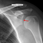 Grade II AC separation with normal coracoclavicular distance of 12.5 mm. Acute scapular fracture extending across the glenoid (red arrow).