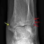 Red arrows: anterior-inferior tibiofibular ligament (AITFL) avulsion fracture. Yellow arrow: medial malleolar fracture.
