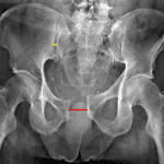 APC II unstable pelvic ring injury with widening of the pubic symphysis (red line) and anterior right sacroiliac joint (yellow line).