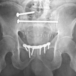 Postoperative radiograph in this patient.